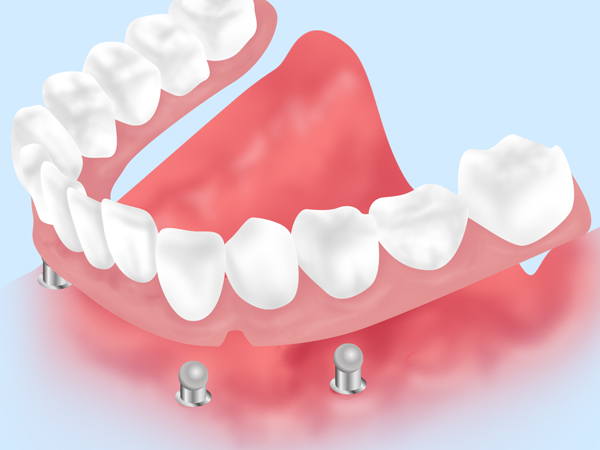 インプラントオーバーデンチャー（自費診療）