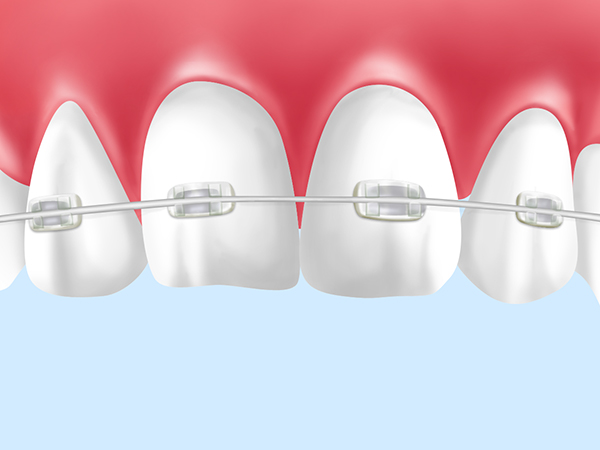 クリアタイプの矯正装置