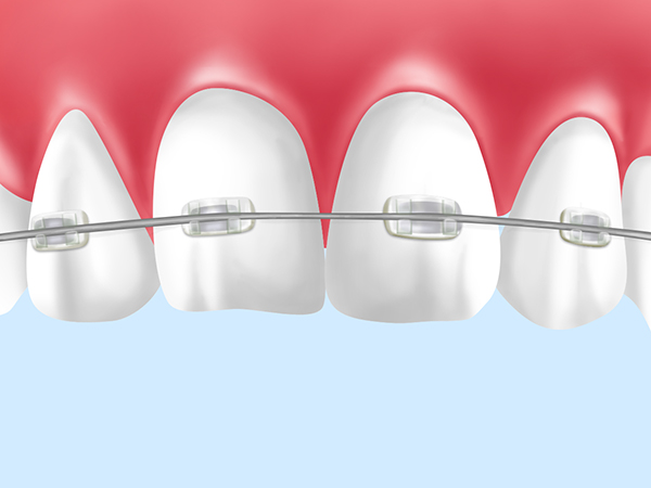 セラミックタイプの矯正装置
