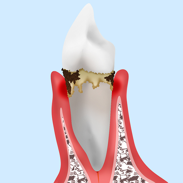 歯周病初期