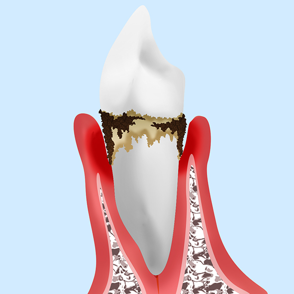 歯周病中期