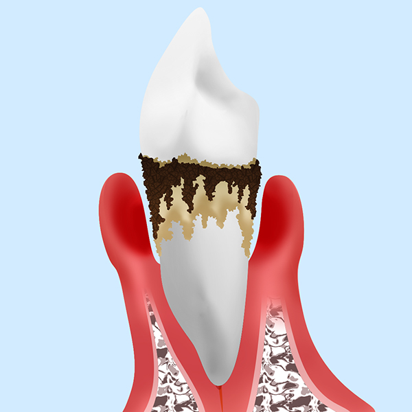 歯周病末期